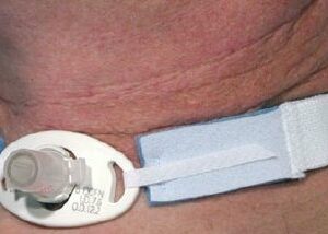 HOLDER, TRACH TUBE NEO (10/BX 10BX/CS) CARFUS
